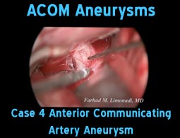 ACOM aneurysms case 4