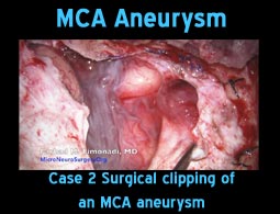 MCA aneurysms case 2