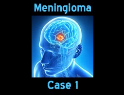 Meningioma case 1