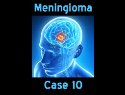 Meningioma case 10