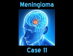 Meningioma case 11
