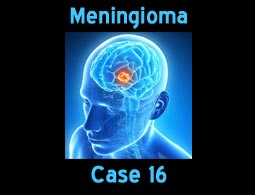 Meningioma case 16