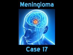 Meningioma case 17
