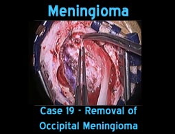 Meningioma case 19