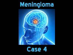 Meningioma case 4