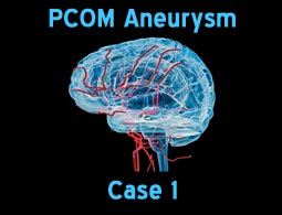 PCOM aneurysms case 1