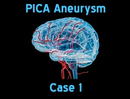 PICA aneurysms case 1
