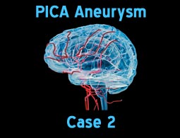 PICA aneurysms case 2