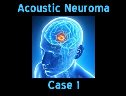 acoustic neuroma case 1