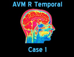 avm r temporal case 1