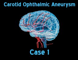 Carotid Ophthalmic Aneurysm case 1