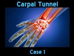 Carpal Tunnel case1