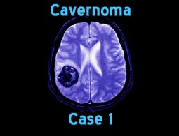 cavernoma case 1