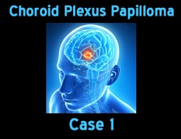Choroid Plexus Papilloma case 1