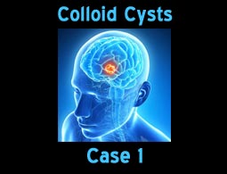 Colloid Cysts case 1