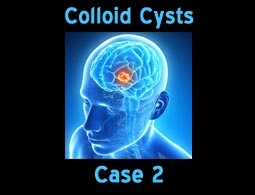 Colloid Cysts case 2