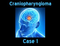 craniopharyngioma case 1