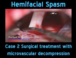 hemifacial spasm case2