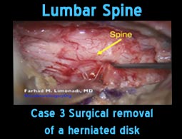 lumbar spine case3