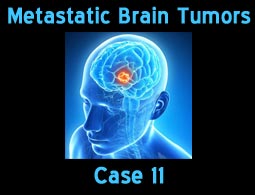 Metastatic case 11