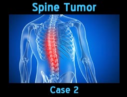 spine tumor case2