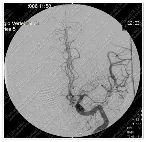 pica aneurysm