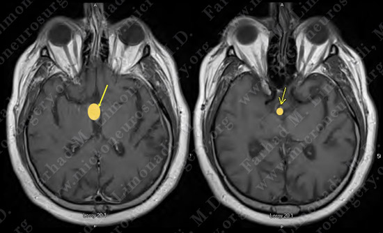 Craniopharyngioma-case1-001