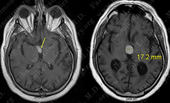Craniopharyngioma-case1-003