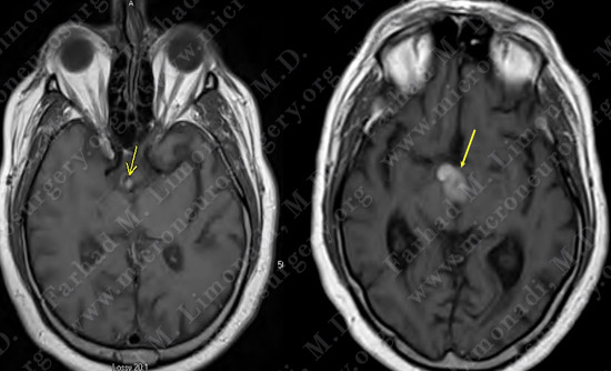 Craniopharyngioma-case1-004