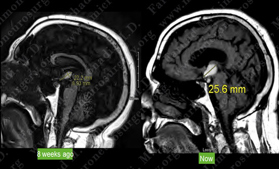 Craniopharyngioma-case1-005