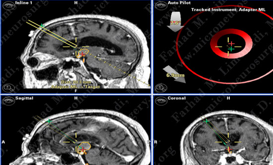 Craniopharyngioma-case1-015