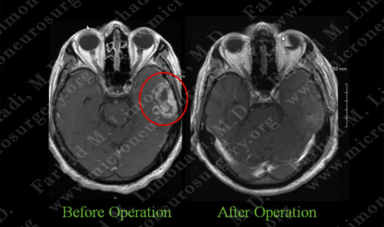 GBM case 6 image 4