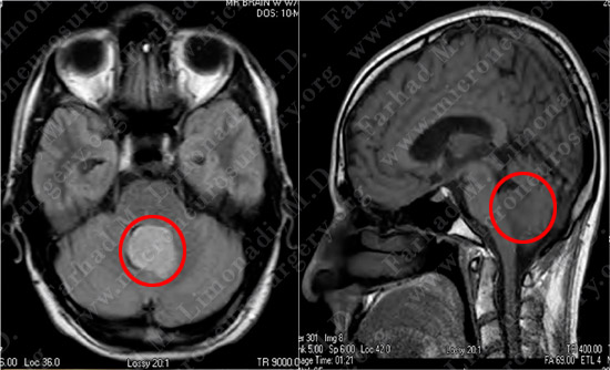 Medulloblastoma Case 1 Image 1