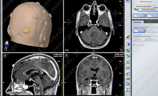 Medulloblastoma Case 1 Image 2