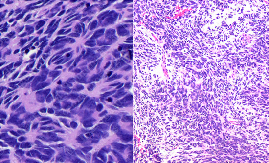 Medulloblastoma Case 1 Image 3