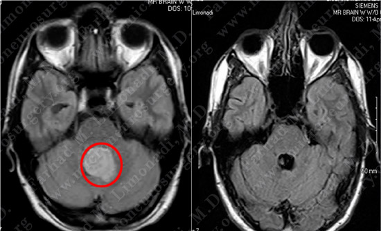 Medulloblastoma Case 1 Image 4