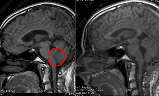 Medulloblastoma Case 1 Image 5