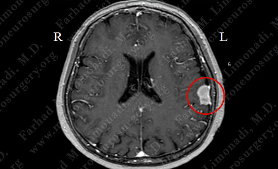 Meningioma Case 18 Image 1