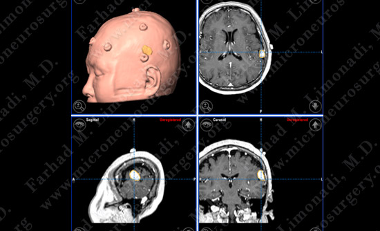 Meningioma Case 18 Image 2