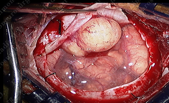 Meningioma Case 18 Image 3