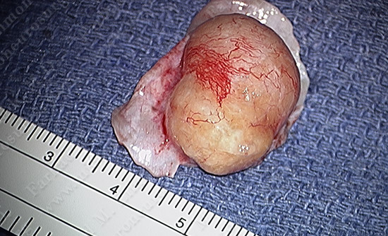 Meningioma Case 18 Image 4
