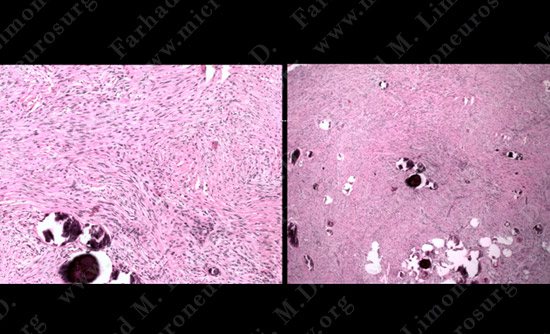 Meningioma Case 18 Image 5