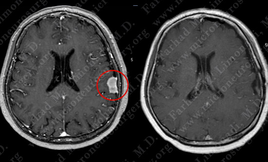 Meningioma Case 18 Image 6