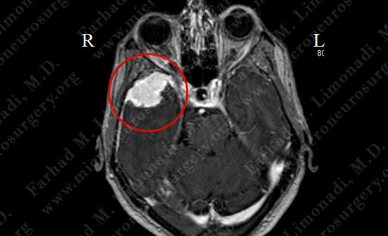 Meningioma Case 19 Image 1