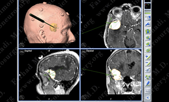 Meningioma Case 19 Image 2