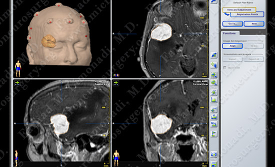 Meningioma Case 19 Image 3