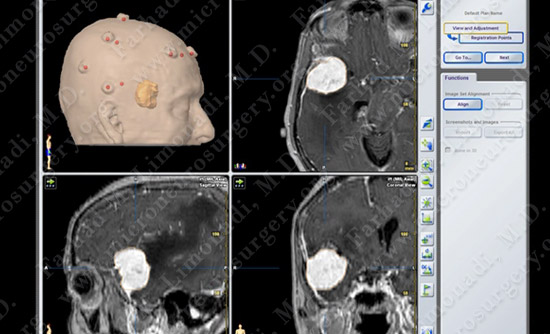 Meningioma Case 19 Image 4