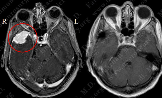 Meningioma Case 19 Image 5