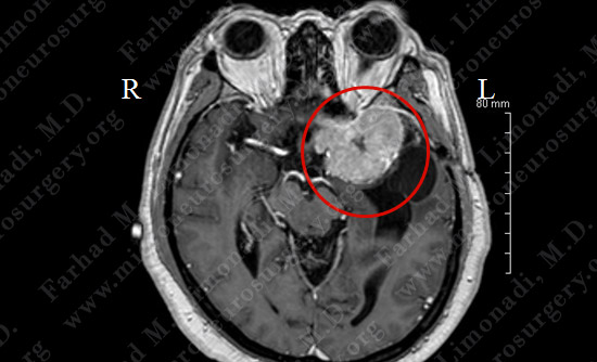 Meningioma Case 19 Image 1