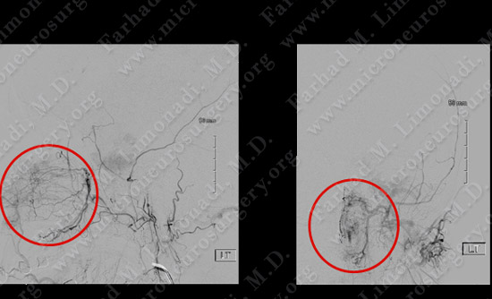 Meningioma Case 19 Image 2